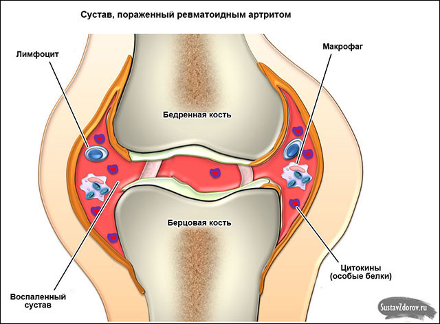 пораженный ревматоидным артритом сустав