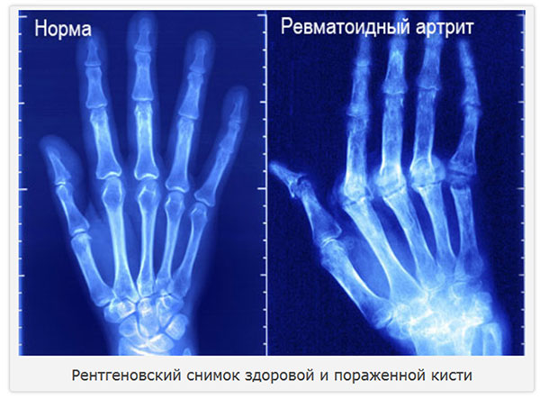 рентгеновский снимок здоровой кисти и пораженной ревматоидным артритом